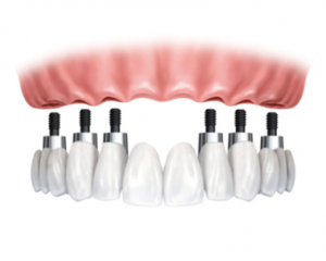 Dental Implant FIXED OPTION