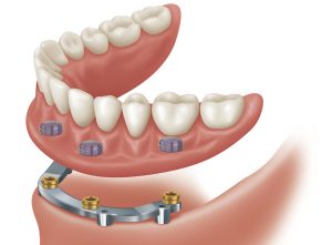 implant-overdenture with Bar OPTION 2
